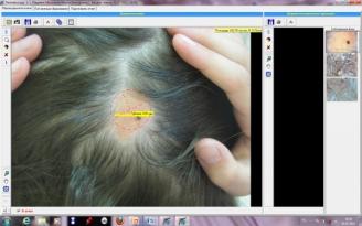 Программа Trichoscience (диагностика заболеваний волос) 